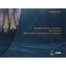 Reabilitação estética em dentes tratados endodonticamente