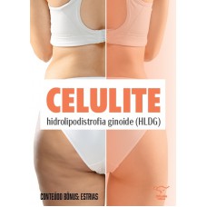 Celulite (hidrolipodistrofia ginoide - HLDG) e Estrias