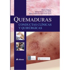 Quemaduras - Conductas clínicas y quirúrgicas