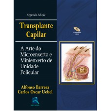 Transplante Capilar