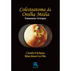 Colesteatoma da Orelha Média