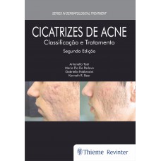 Cicatrizes de Acne