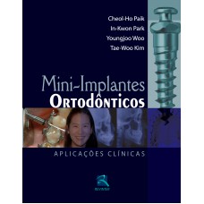 Mini-Implantes Ortodônticos