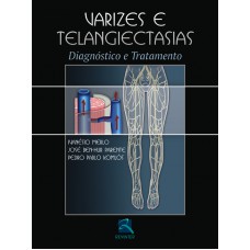 Varizes e Telangiectasias