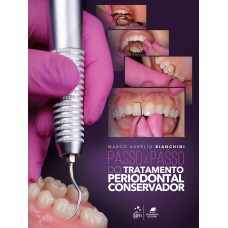 Passo a Passo do Tratamento Periodontal Conservador